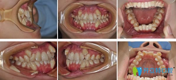 青島拜博口腔矯正牙齒前 青島拜博口腔矯正牙齒前