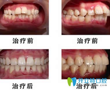 <!--<i data=20240703-sp></i>-->齒科<!--<i data=20240703-sp></i>-->牙齒矯正對(duì)比圖