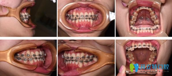 金屬托槽矯正牙齒進(jìn)行中 金屬托槽矯正牙齒進(jìn)行中