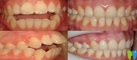 北京斯邁爾開頜/牙列不齊正畸效果圖