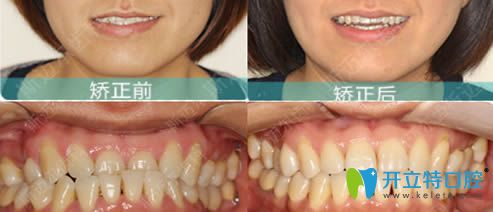 北京斯邁爾齒科張棟梁舌側(cè)正畸效果圖