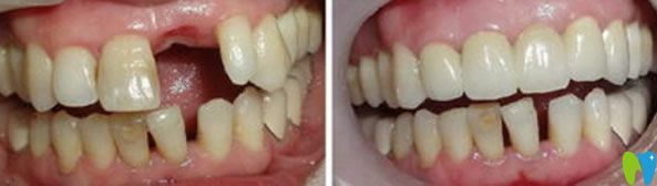 羅新宇院長種植牙代表案例