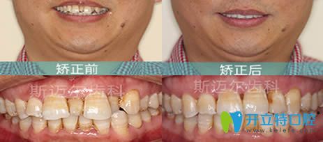 北京斯邁爾齒科張棟梁牙齒正畸效果對(duì)比圖