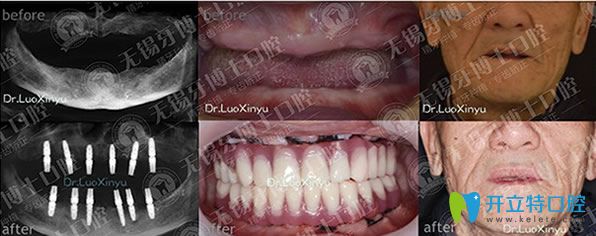 牙博士口腔樸東信院長(zhǎng)全口種植牙代表案例