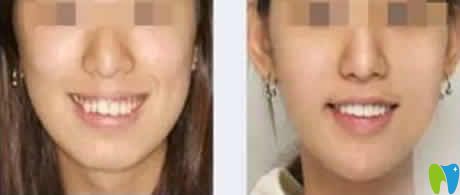 泉州維樂口腔王燕燕主任牙齒矯正案例效果圖
