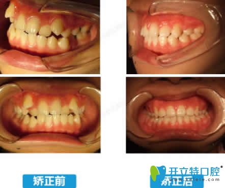 泉州維樂口腔黃鴻進牙齒矯正前后效果對比圖