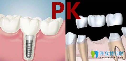 關(guān)于種牙好還是鑲牙好？請(qǐng)看價(jià)格/壽命/優(yōu)勢(shì)三方面大比拼