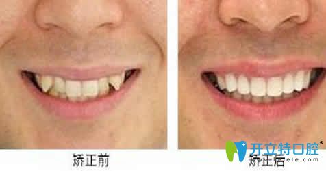 虎牙矯正前后效果對(duì)比圖