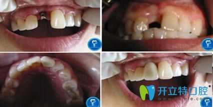 青島天皓口腔門診趙軍醫(yī)生種植牙案例效果對比圖 青島天皓口腔門診趙軍醫(yī)生種植牙案例效果對比圖