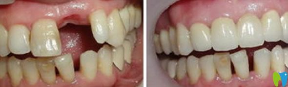 種植牙代表<span style=