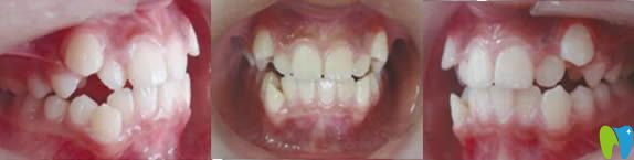 青島天皓口腔牙齒矯正前照片 青島天皓口腔牙齒矯正前照片