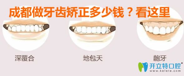 成都做牙齒矯正多少錢?看時代天使/隱適美/正雅牙套價格表