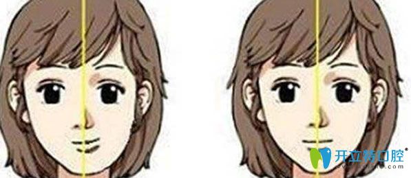 牙齒矯正齙牙改變臉型