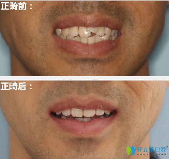 成都西區(qū)口腔28歲矯正牙齒前后對比照