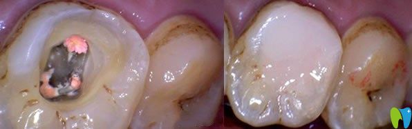 急性牙髓炎治療方法