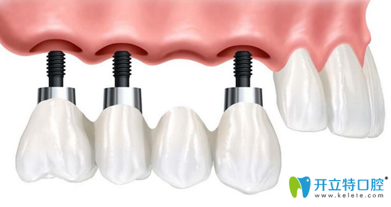 種植牙到底好不好，該不該做