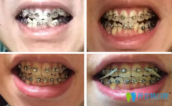 合肥華美口腔牙齒矯正2年間變化過程圖展示 合肥華美口腔牙齒矯正2年間變化過程圖展示