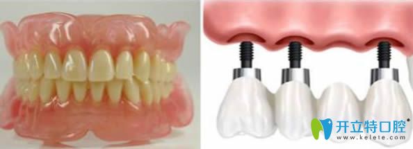 關(guān)于鑲牙好還是種牙好請看這里