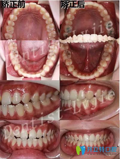 28歲顧客矯正牙齒前后對(duì)比照