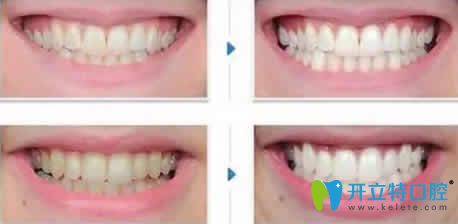 長沙雅美口腔牙齒冷光美白前后效果對比圖 長沙雅美口腔牙齒冷光美白前后效果對比圖