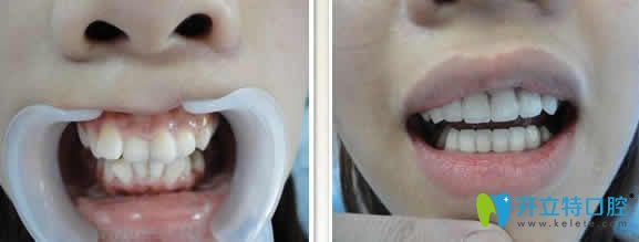 長沙牙大夫口腔周權(quán)牙齒矯正案例效果圖