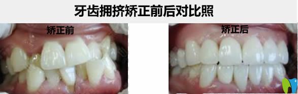 哈爾濱圣琪王曉琳院長牙齒擁擠不拔牙矯正前后對比照