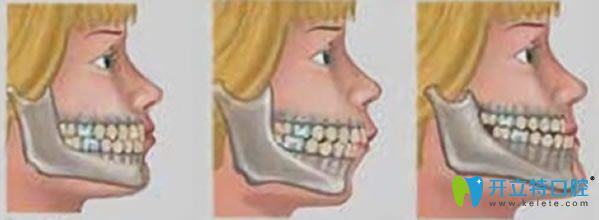 齙牙妹顏值氣質(zhì)齊飆升奧秘 請(qǐng)看牙齒矯正會(huì)后悔一輩子嗎