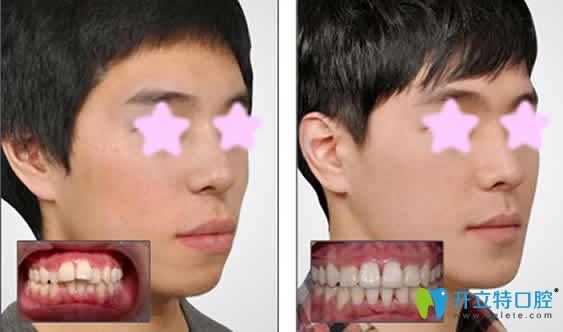 26歲牙齒矯正前后效果對(duì)比圖
