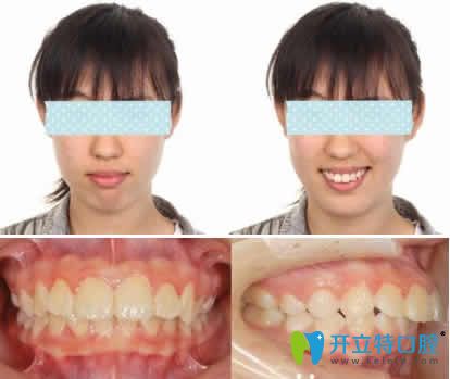 妹子在無錫通善口腔做隱形牙齒矯正價(jià)格不貴但齙牙不見了 