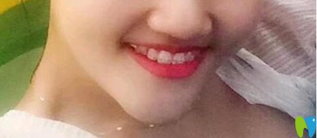 青島牙博士口腔戴半隱形牙套第422天牙齒變化情況