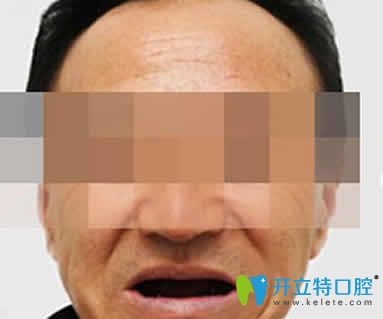 無錫通善口腔怎么樣 王杏松院長(zhǎng)即刻種植牙案例及效果反饋