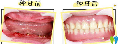 沈陽歡樂口腔全口牙缺失種植案例