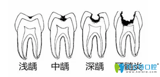 牙壞了一半爛掉了，這樣的蟲牙是補(bǔ)好還是拔好？