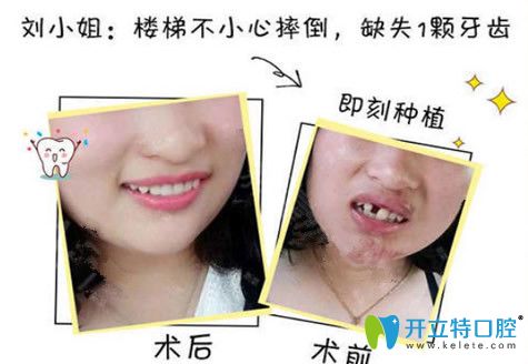 孫延單顆牙齒缺失即刻種植案例
