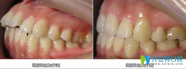 泉州維樂牙科雙頜前突矯正對比照