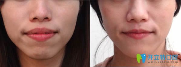 成人凸嘴矯正案例及帶牙套前后對(duì)比照