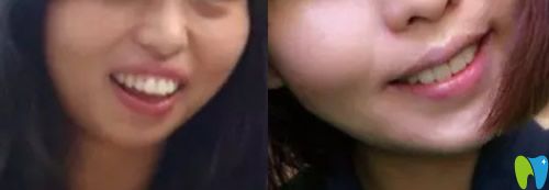 重慶牙科哪家好，看美維口腔齙牙矯正案例效果圖