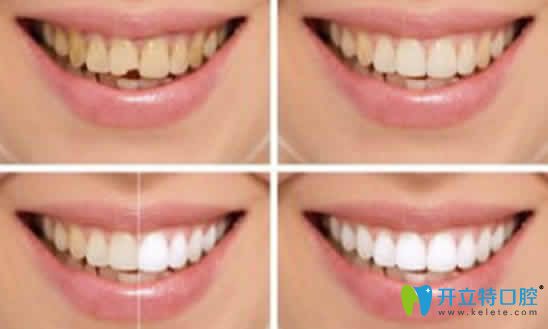 牙齒做冷光美白前后對(duì)比照