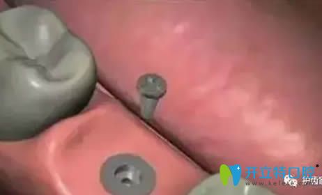 等待骨結(jié)合期