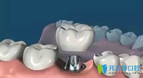 種植牙過程之戴上牙冠