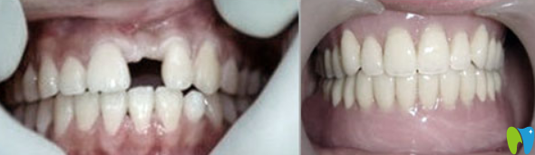 大連佳美口腔種植牙效果怎么樣