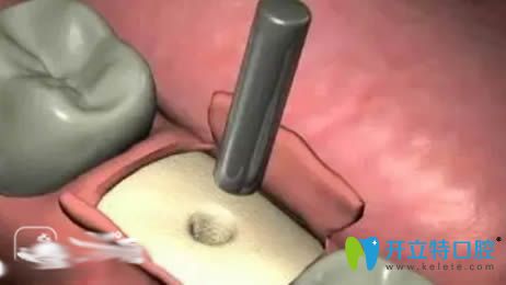 種植牙手術(shù)過程之植入種植體