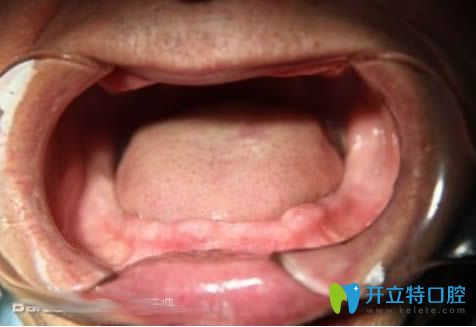 我?guī)Я?0年的活動假牙,這次終于去廣州瑞泰做了全口種植牙