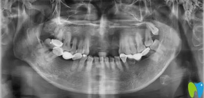 種植牙齒前拍片檢查