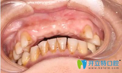 成都新橋口腔種植牙齒前
