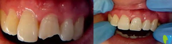 門牙缺失美容冠修復(fù)代表案例