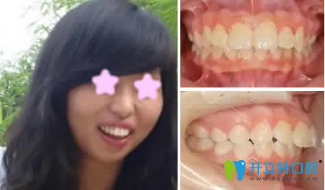 齙牙妹在昆明尚愛韓美口腔做牙齒矯正一年后紅遍朋友圈