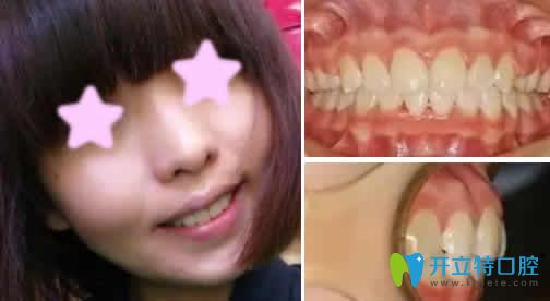 我在昆明尚愛韓美口腔做隱形牙齒矯正一年的樣子