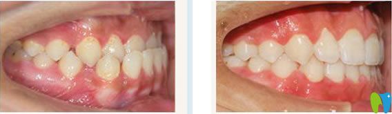 南寧柏樂(lè)口腔陳世穩(wěn)門(mén)牙反頜矯正案例及前后對(duì)比效果