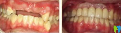 門(mén)牙缺失隱形義齒修復(fù)效果圖